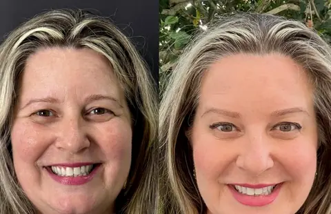 Antes e depois do rejuvenescimento facial de uma paciente