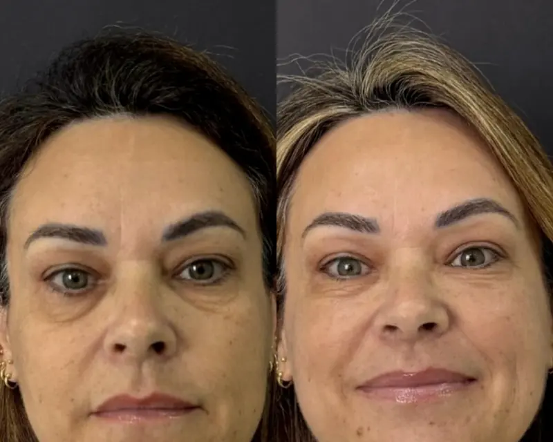 Antes e depois da harmonização facial de uma paciente de 53 anos