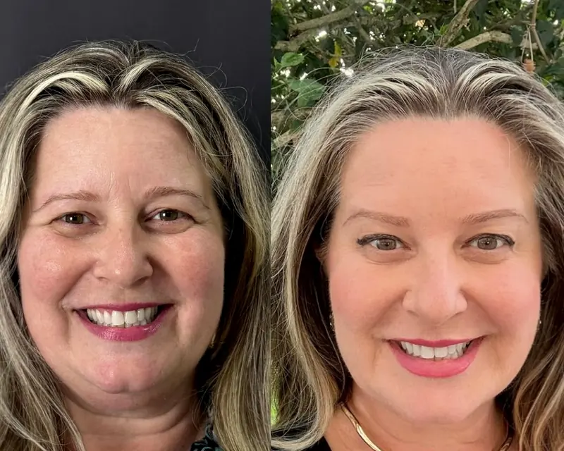 Antes e depois do rejuvenescimento facial de uma paciente